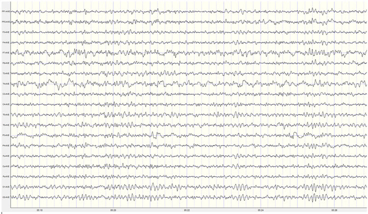 Second recording average reference montage showing symmetrical posterior rhythm